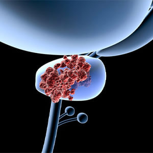cancer-de-prostata